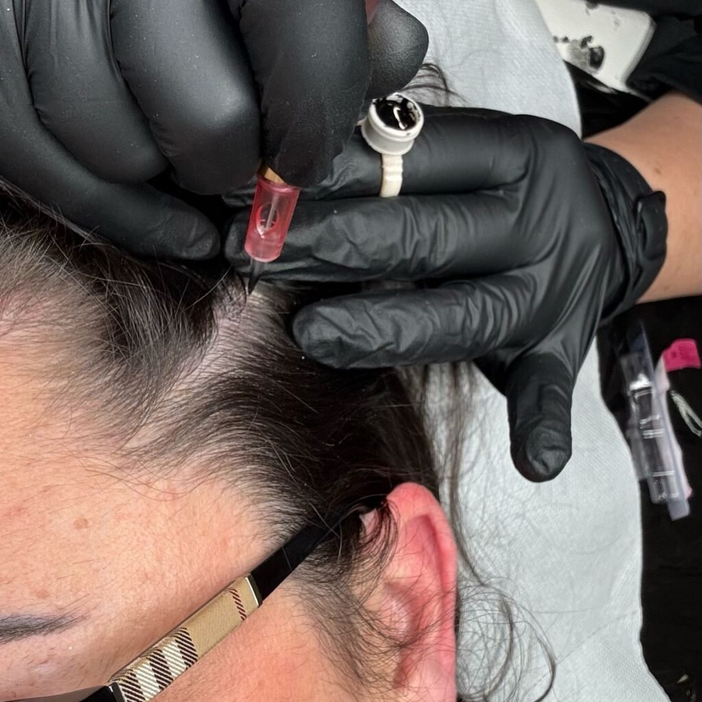 tricopigmentation sur emilie